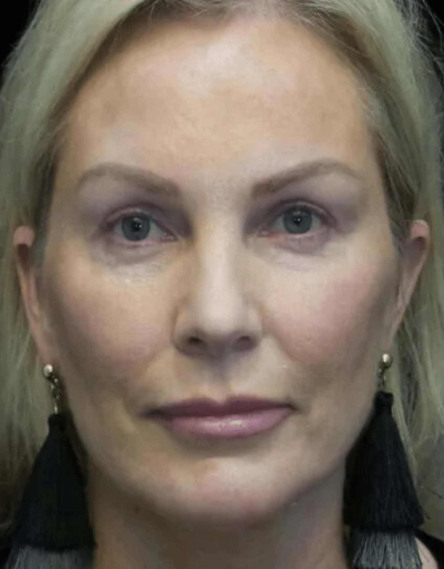 SMART Facelift Before & After