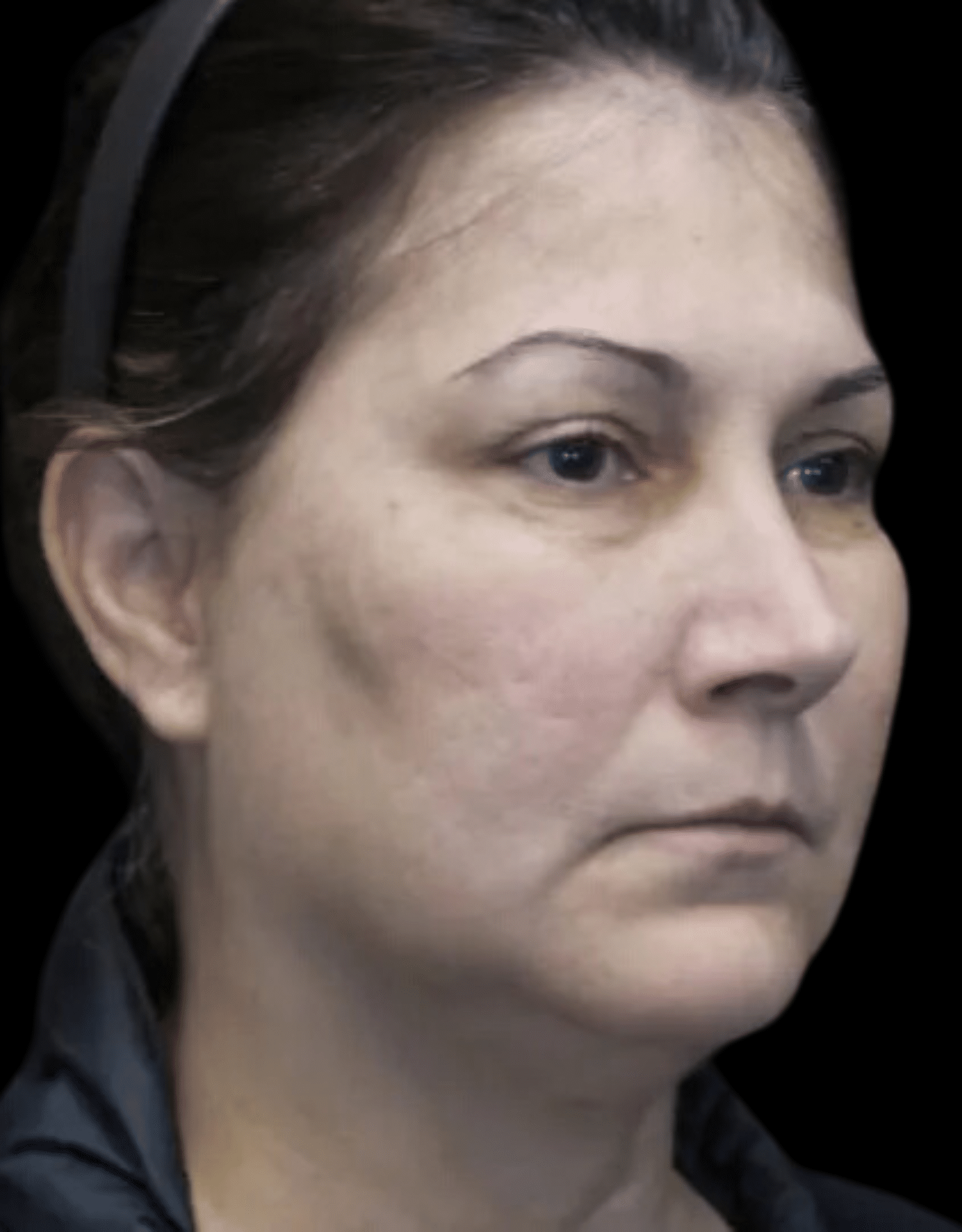 SMART Facelift Before & After