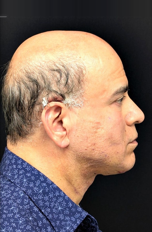Carlos 24 hours after ReLift, profile view