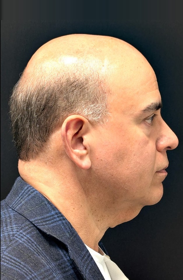 Carlos before ReLift, profile view