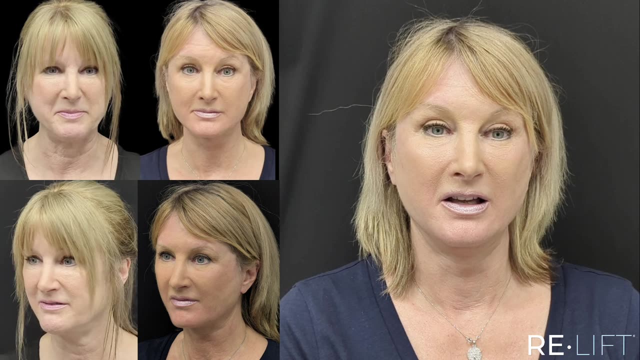ReLift patient before and one week after