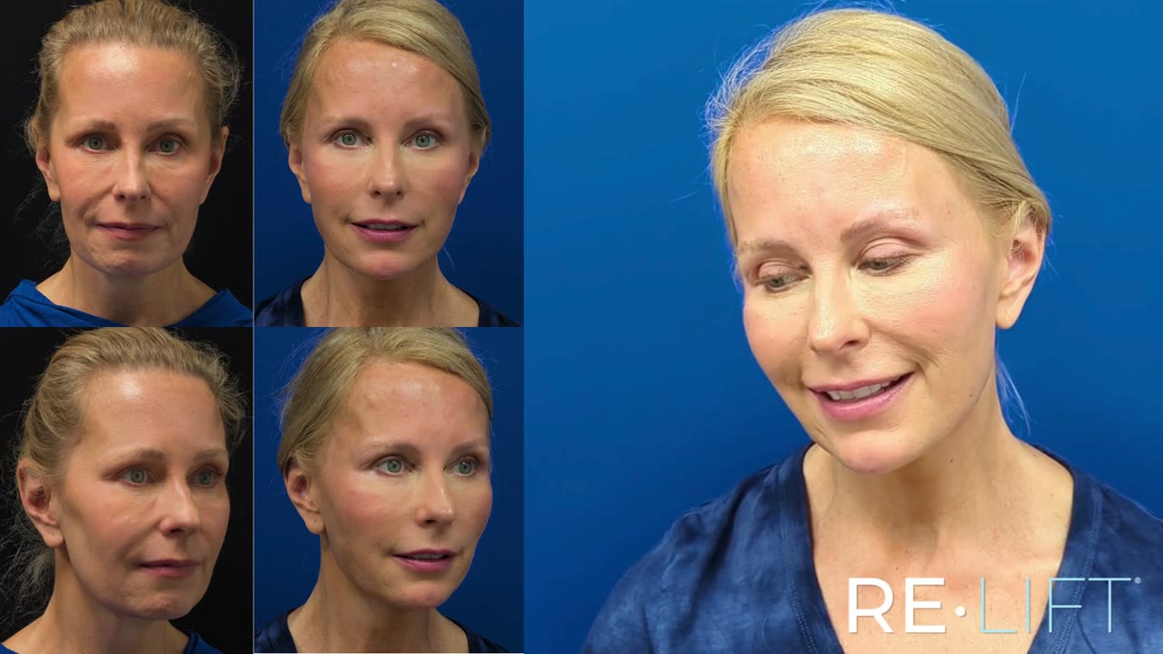 ReLift patient before and two weeks after