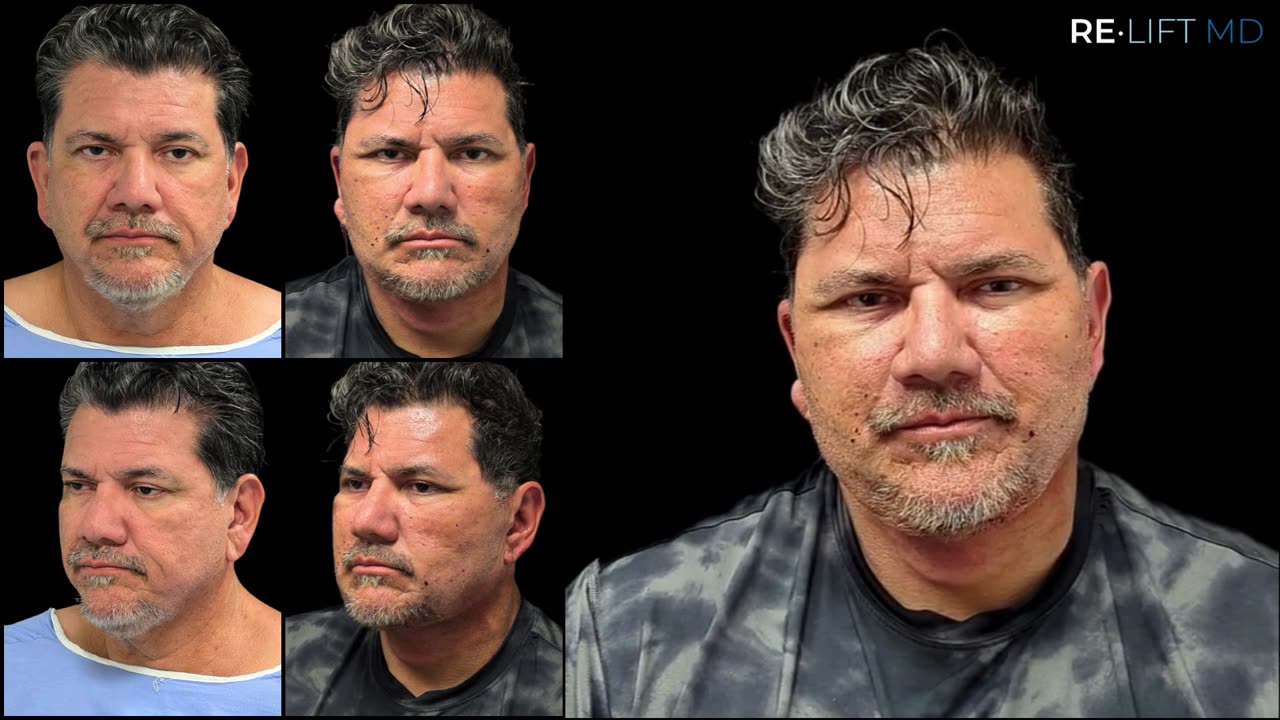 ReLift patient before and 24 hours after