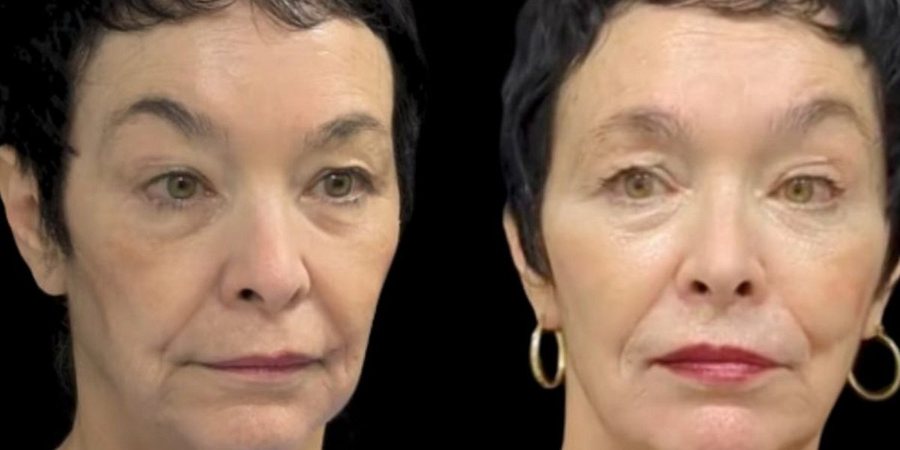 Real RE•LIFT patient, before and after