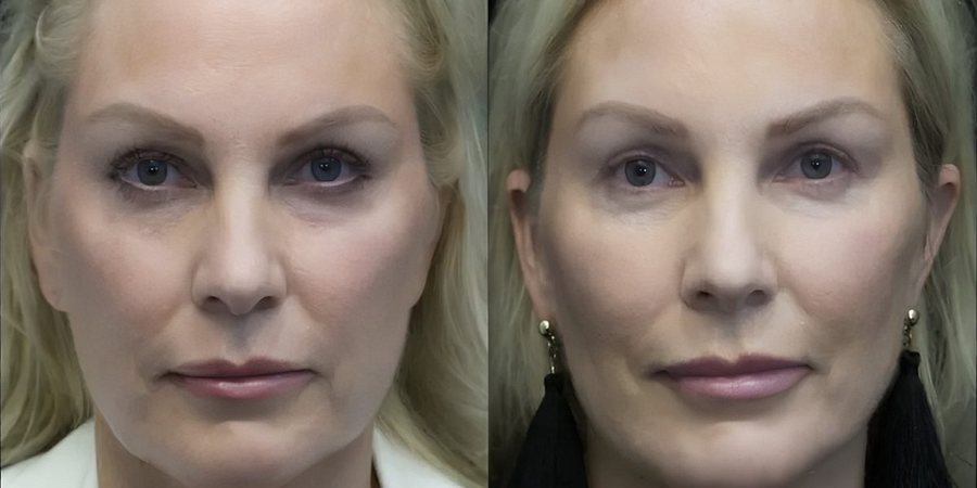Real RE•LIFT patient, before and after