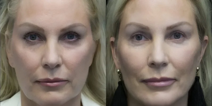 Real RE•LIFT patient, before and after