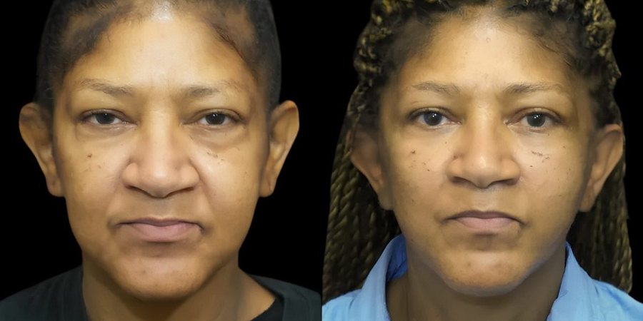 Real RE•LIFT patient, before and after