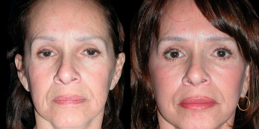 Real RE•LIFT patient, before and after