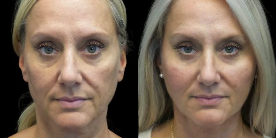 Real RE•LIFT patient, before and after