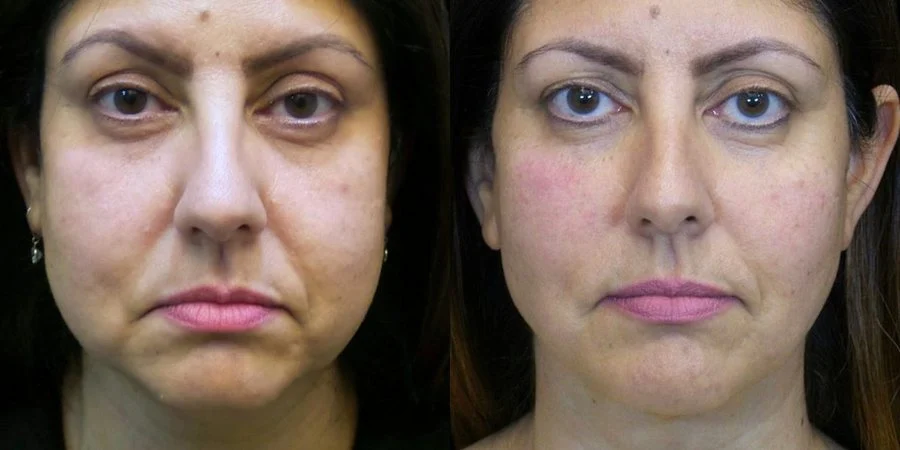 Real RE•LIFT patient, before and after