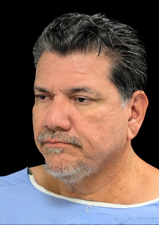 Patient before a ReLift procedure, angled view