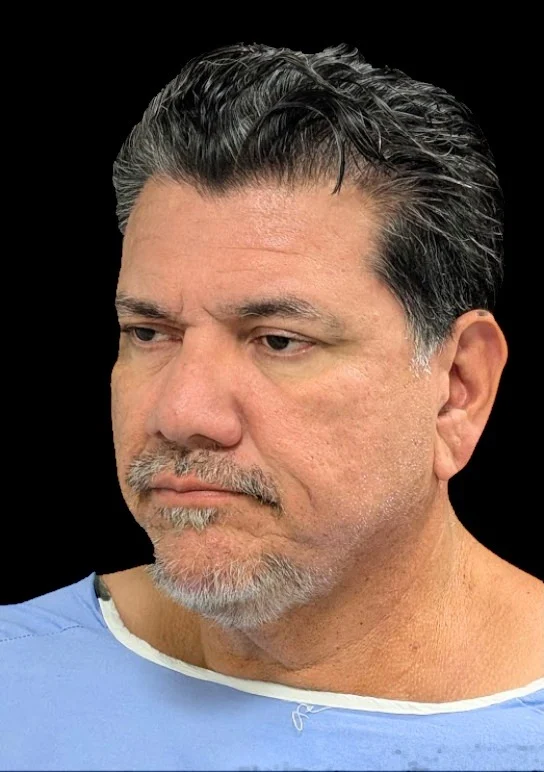 Patient before a ReLift procedure, angled view